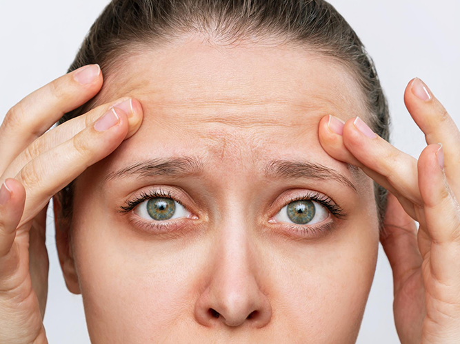 Forehead lines