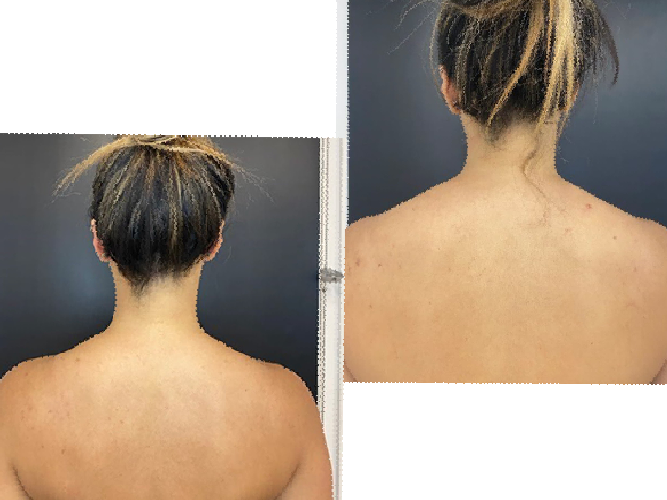 Shoulder Contouring