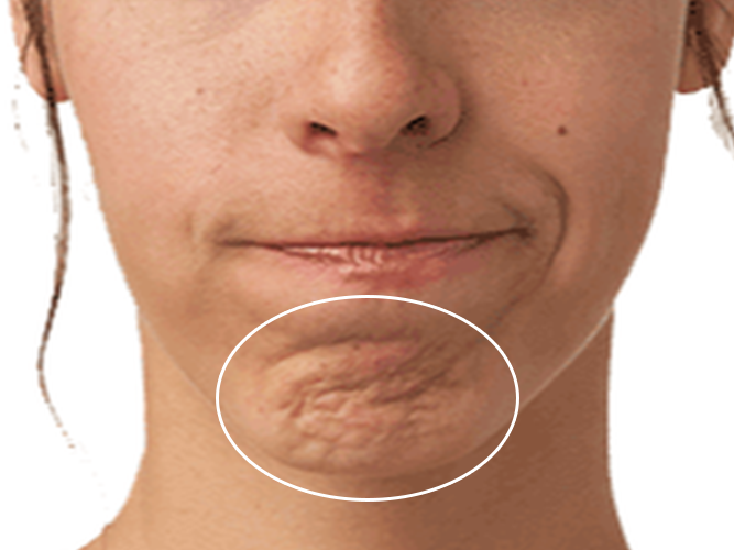 chin dimpling